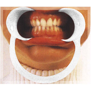 Dental-Instruments - Other Retractors Disposable Plastic